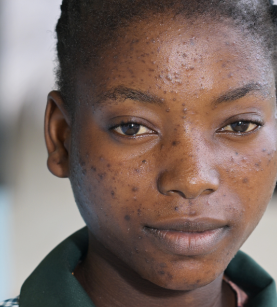 Una via d'uscita dalla povertà in Zambia 